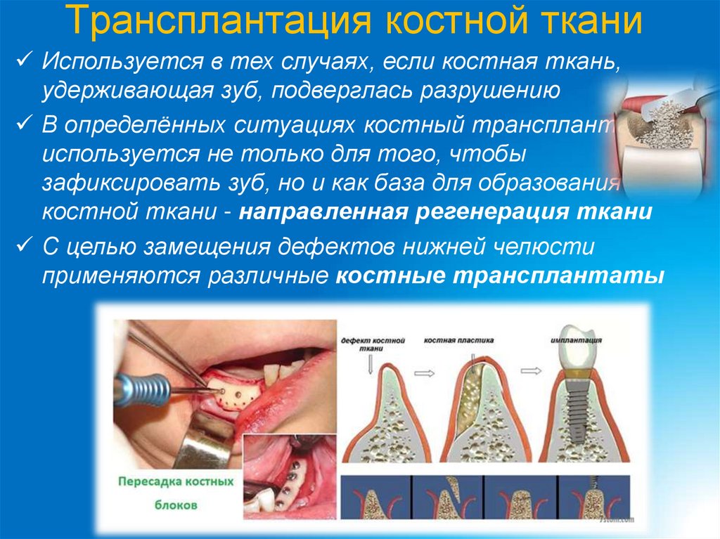 Трансплантация костной ткани