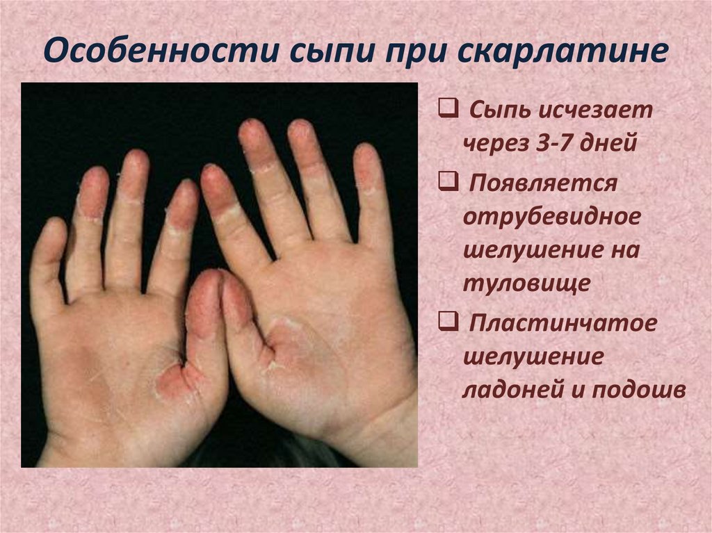 Особенности сыпи при скарлатине