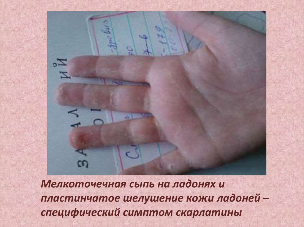 Мелкоточечная сыпь на ладонях и пластинчатое шелушение кожи ладоней – специфический симптом скарлатины