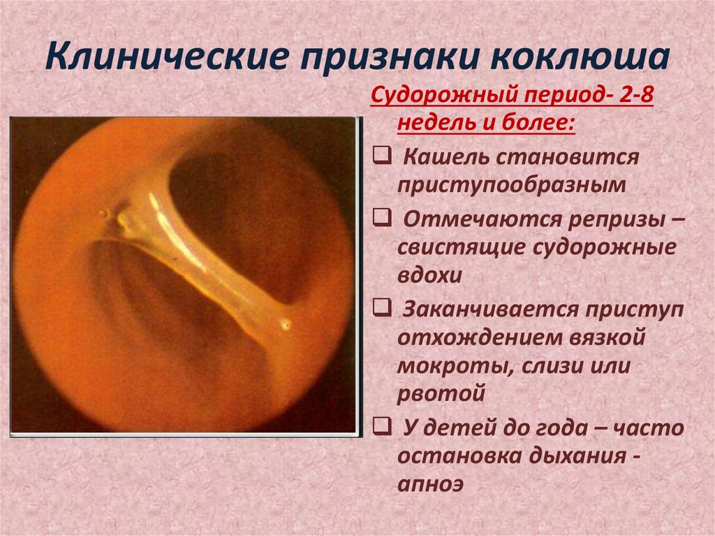 Клинические признаки коклюша