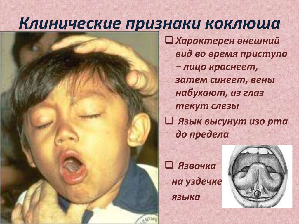 Клинические признаки коклюша