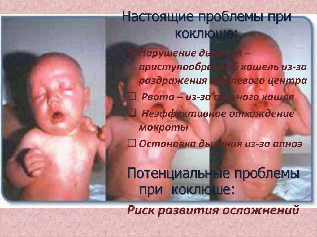 Настоящие проблемы при коклюше: