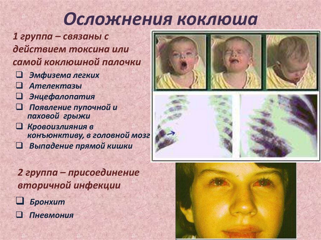Осложнения коклюша