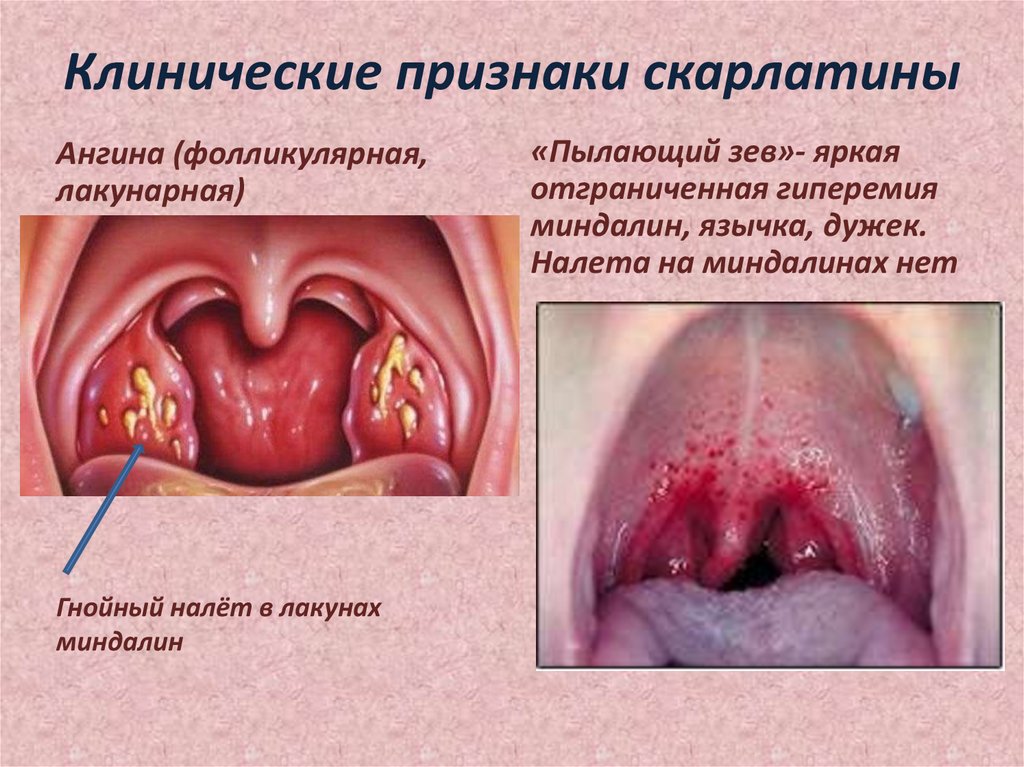 Клинические признаки скарлатины
