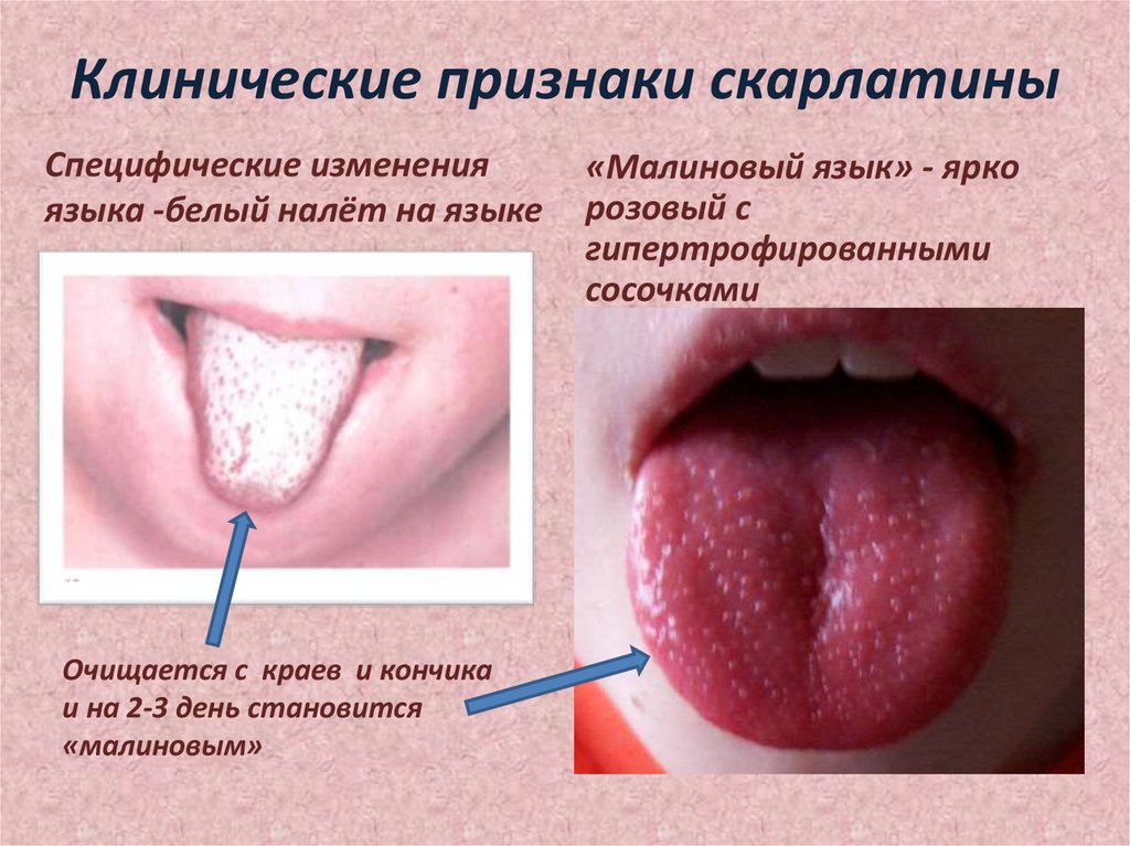 Клинические признаки скарлатины
