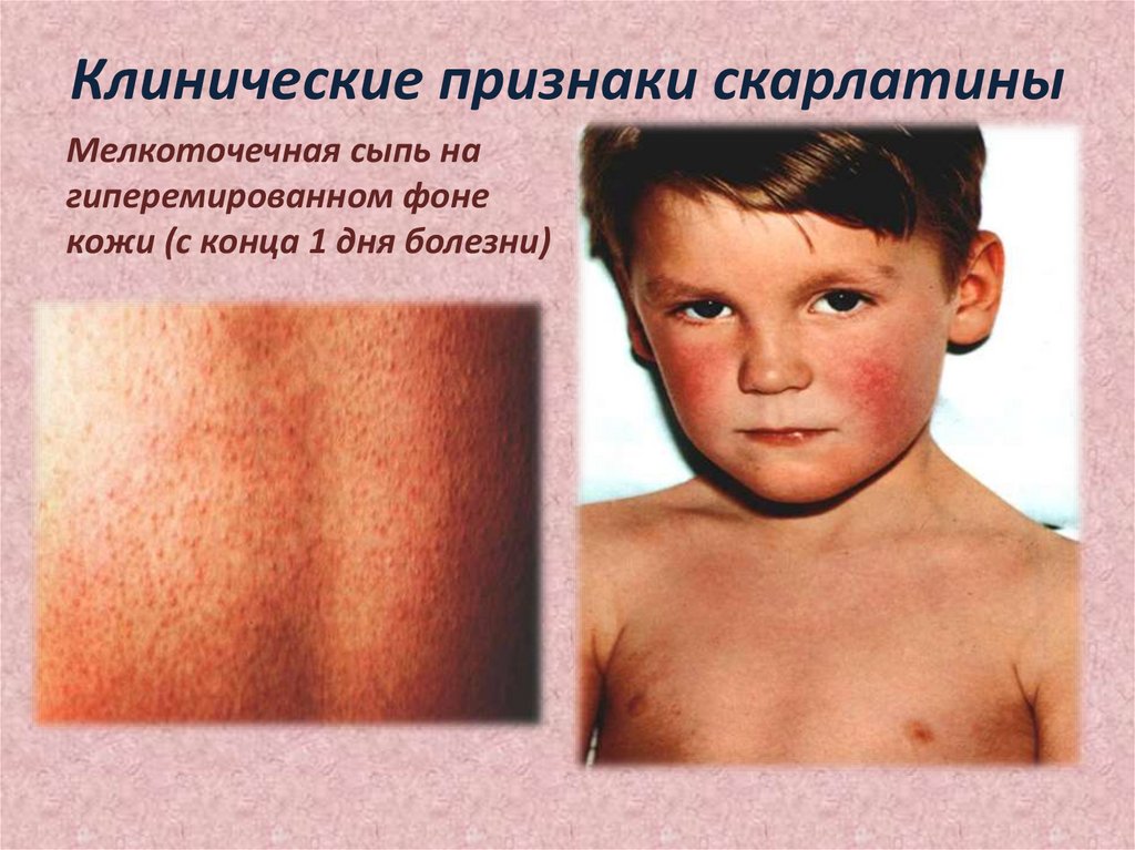 Клинические признаки скарлатины