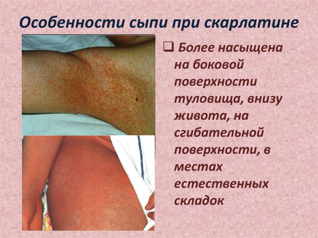 Особенности сыпи при скарлатине
