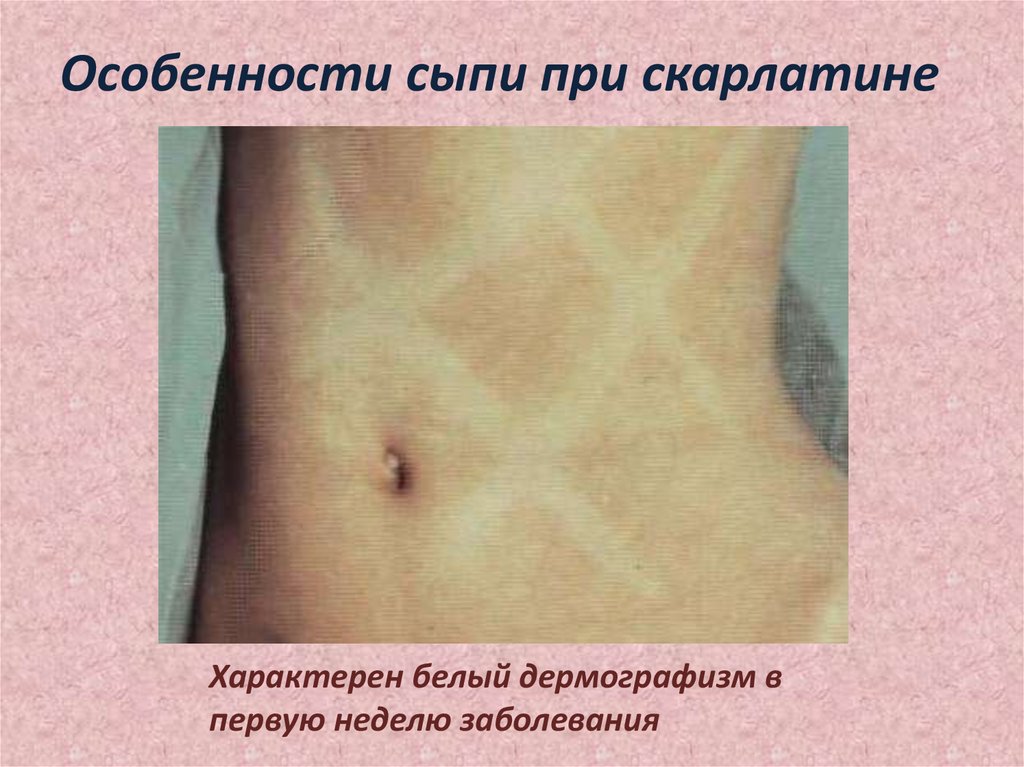 Характерен белый дермографизм в первую неделю заболевания