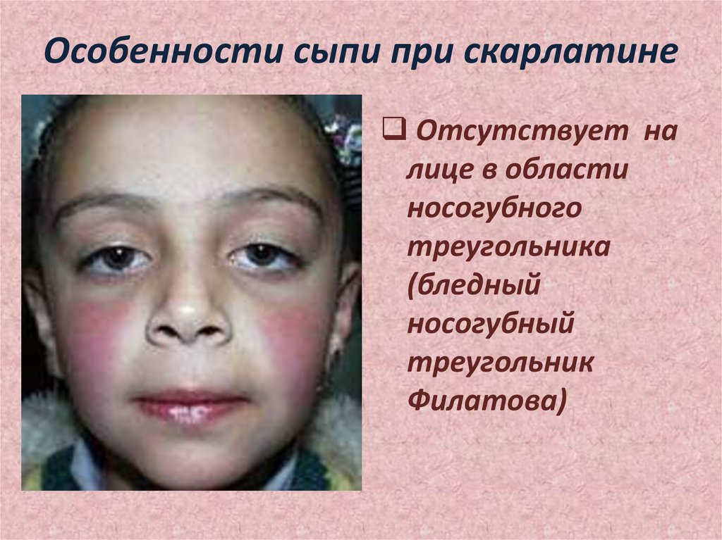 Особенности сыпи при скарлатине