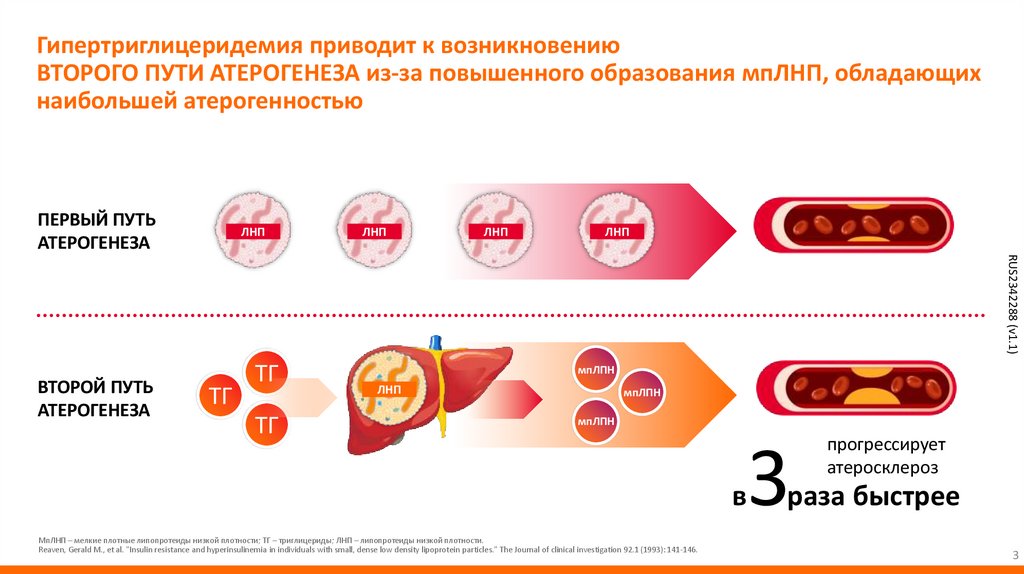 Гипертриглицеридемия приводит к возникновению ВТОРОГО ПУТИ АТЕРОГЕНЕЗА из-за повышенного образования мпЛНП, обладающих