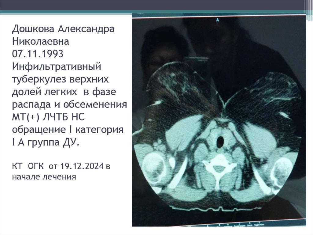 Дошкова Александра Николаевна 07.11.1993 Инфильтративный туберкулез верхних долей легких в фазе распада и обсеменения МТ(+)