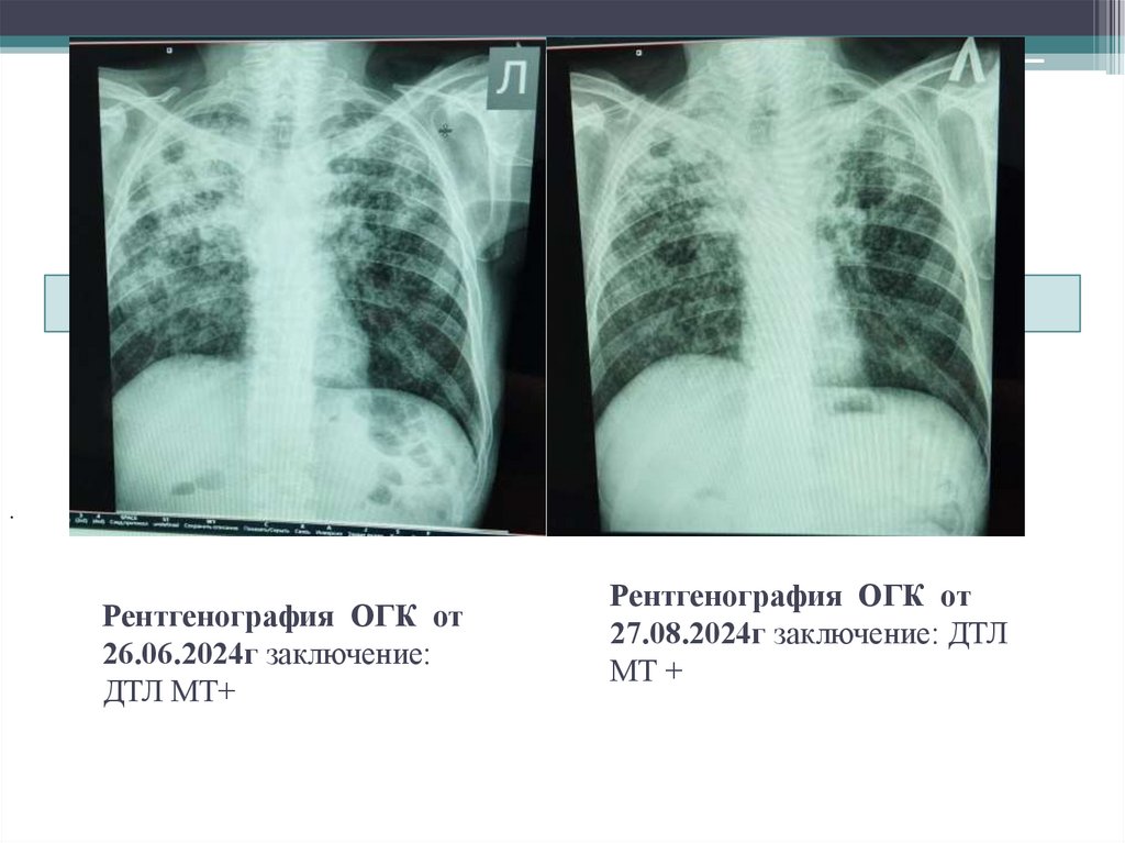 Рентгенография ОГК от 26.06.2024г заключение: ДТЛ МТ+