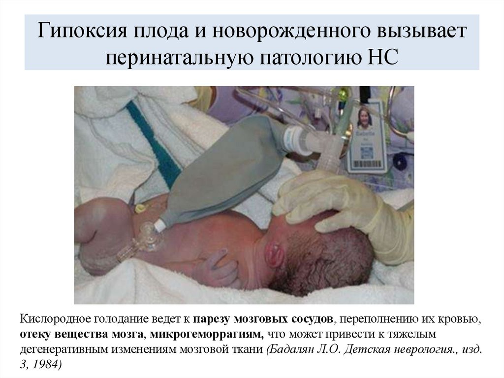 Гипоксия плода и новорожденного вызывает перинатальную патологию НС