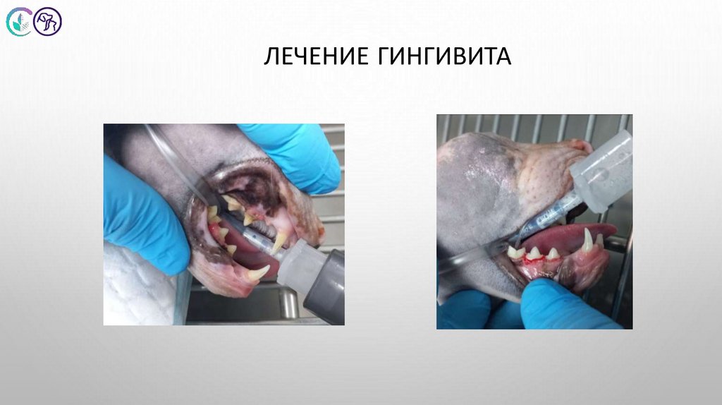 Лечение гингивита