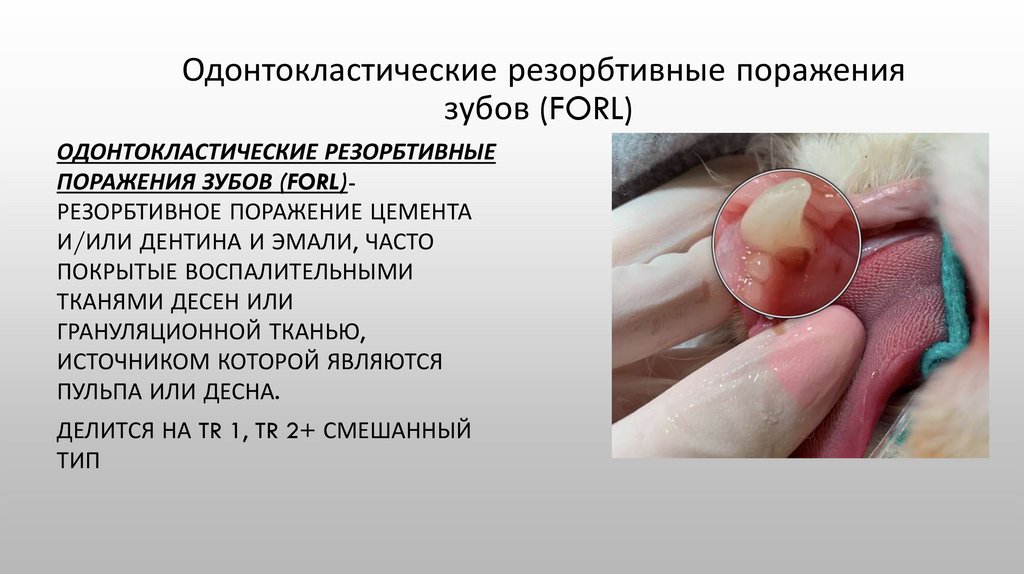 Одонтокластические резорбтивные поражения зубов (FORL) 