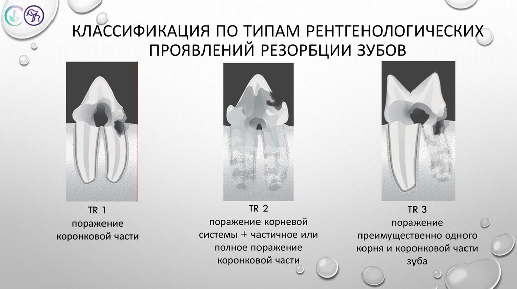 Классификация по типам рентгенологических проявлений резорбции зубов