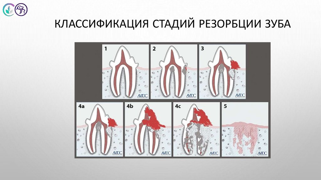 Классификация стадий резорбции зуба