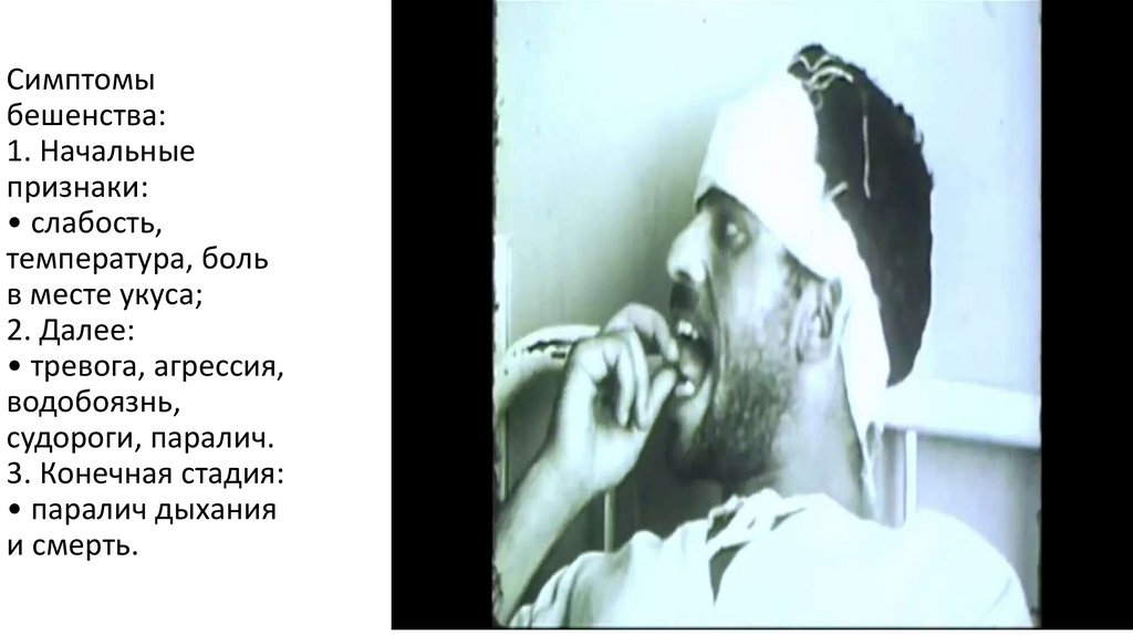 Симптомы бешенства: 1. Начальные признаки: • слабость, температура, боль в месте укуса; 2. Далее: • тревога, агрессия,