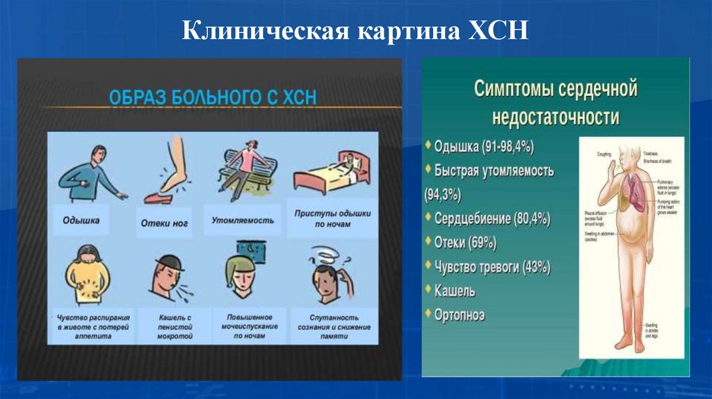 Клиническая картина ХСН
