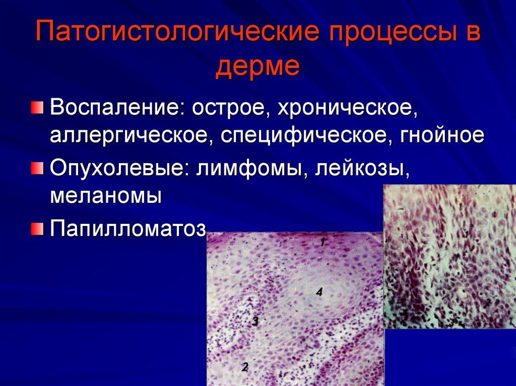 Патогистологические процессы в дерме