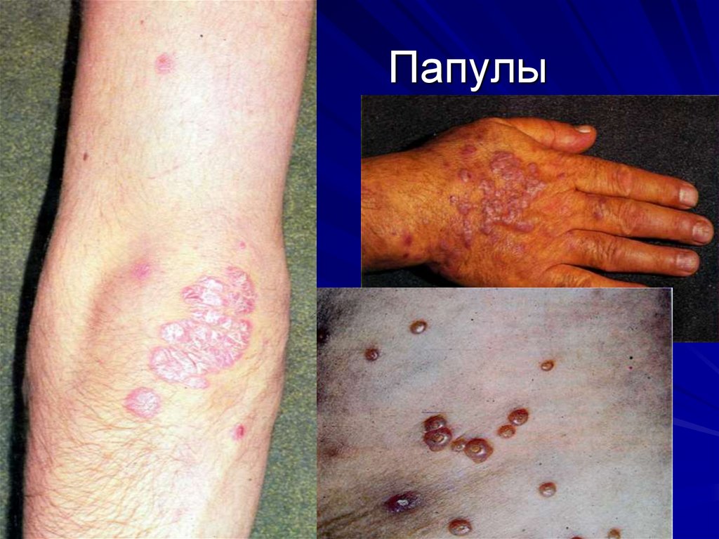 Папулы