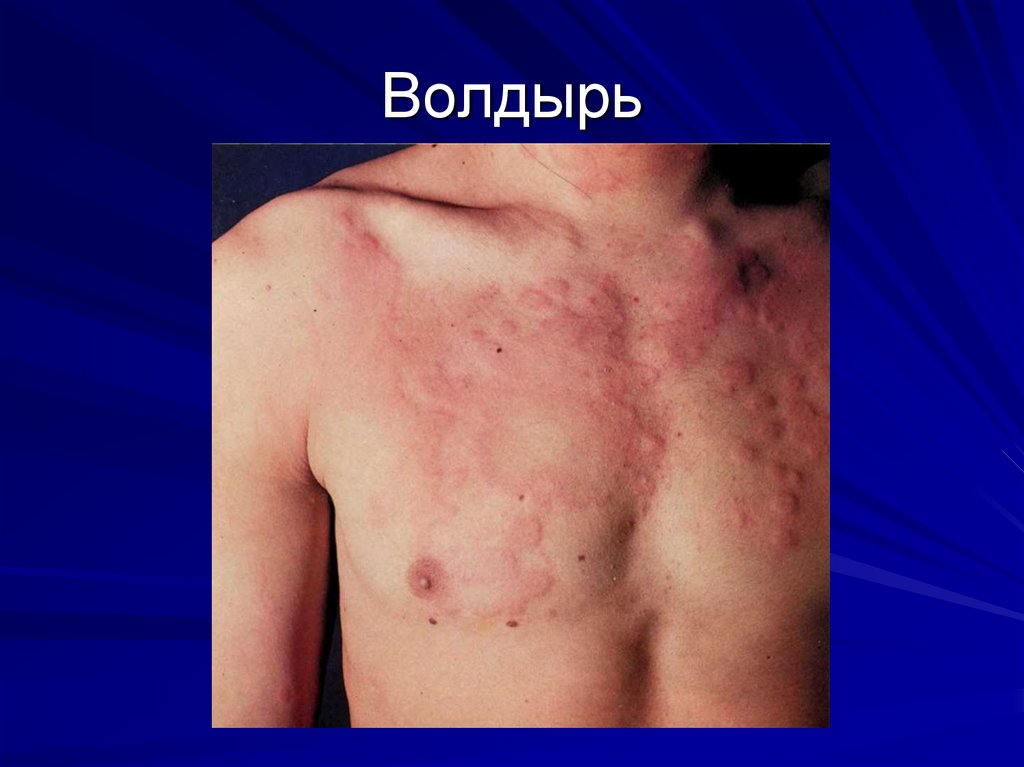 Волдырь