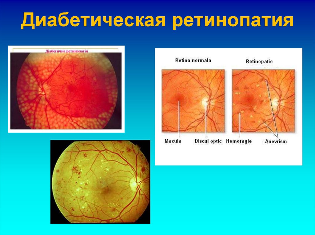 Диабетическая ретинопатия