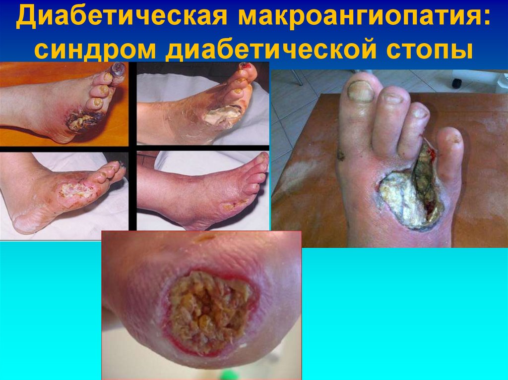 Диабетическая макроангиопатия: синдром диабетической стопы