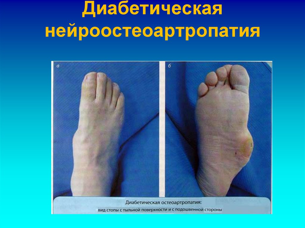 Диабетическая нейроостеоартропатия