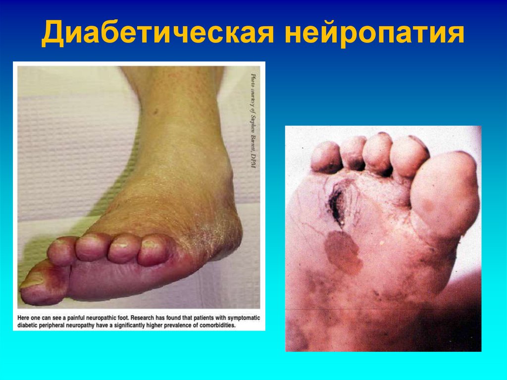 Диабетическая нейропатия