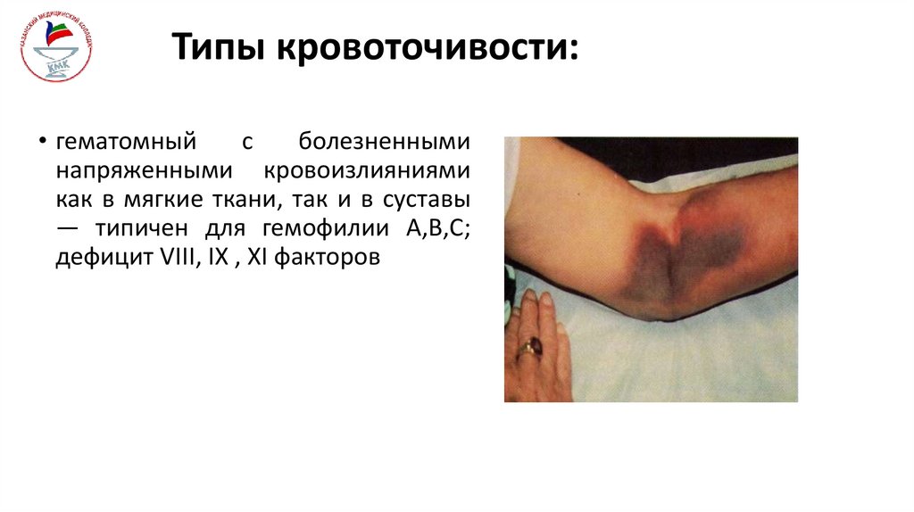 Типы кровоточивости: