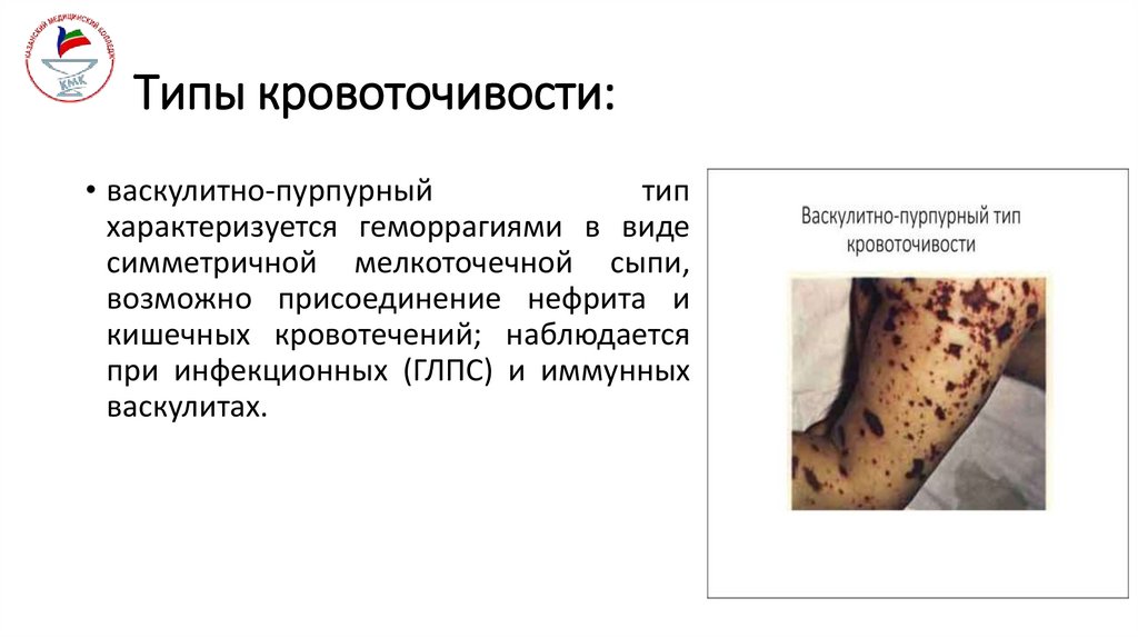 Типы кровоточивости: