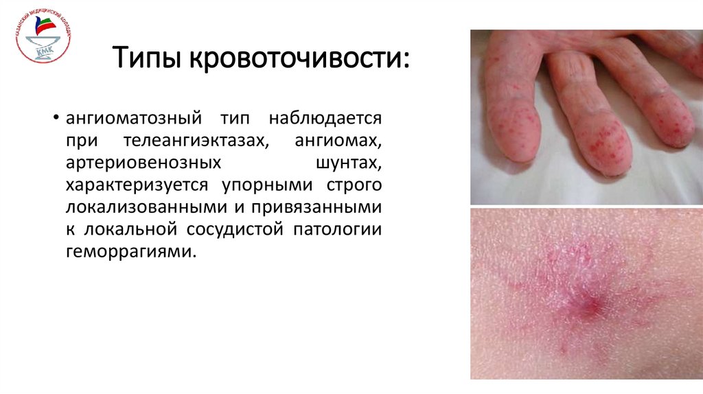 Типы кровоточивости: