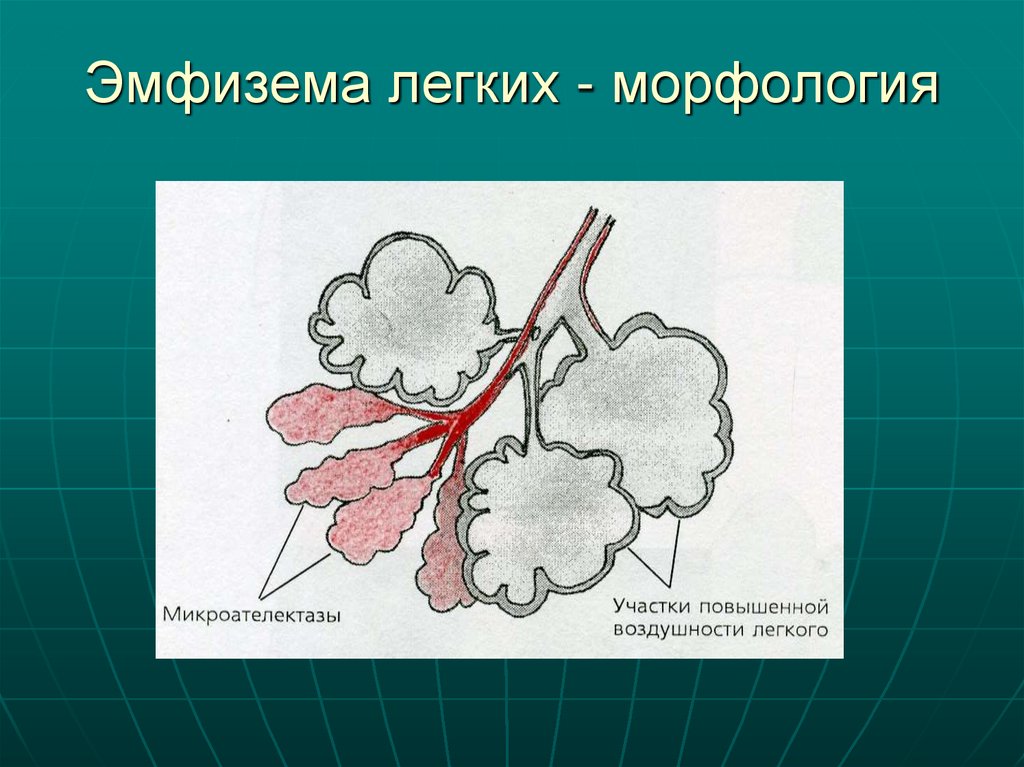 Эмфизема легких - морфология