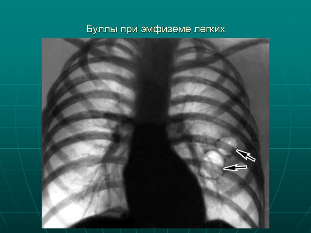 Буллы при эмфиземе легких