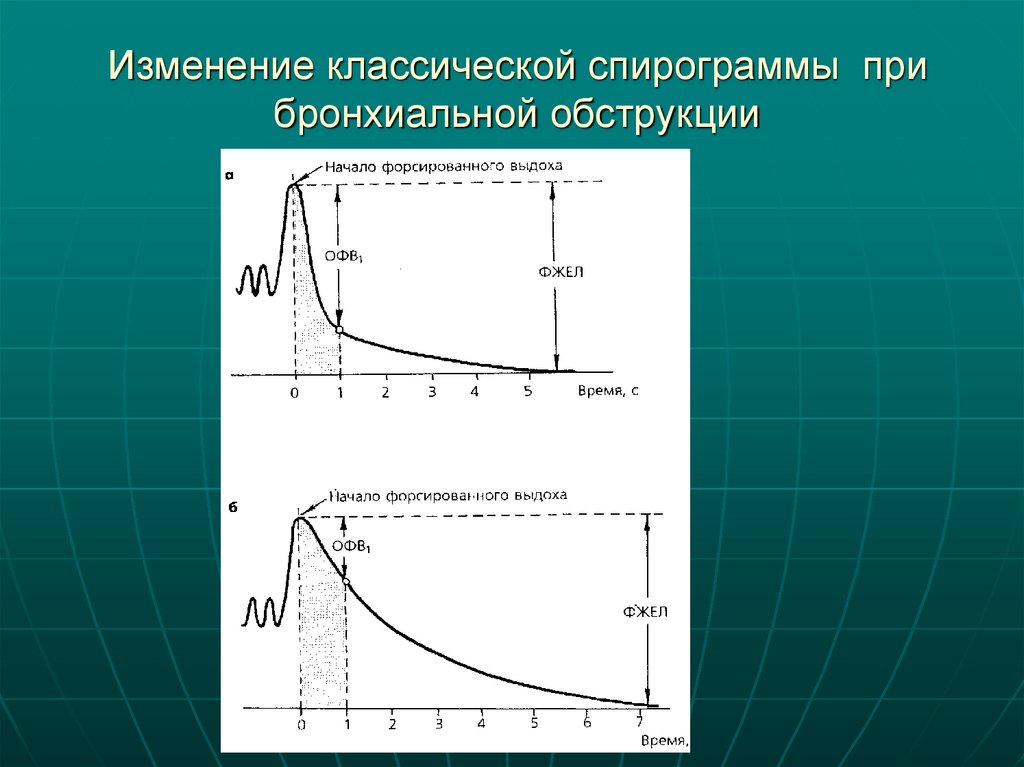 Изменение классической спирограммы при бронхиальной обструкции