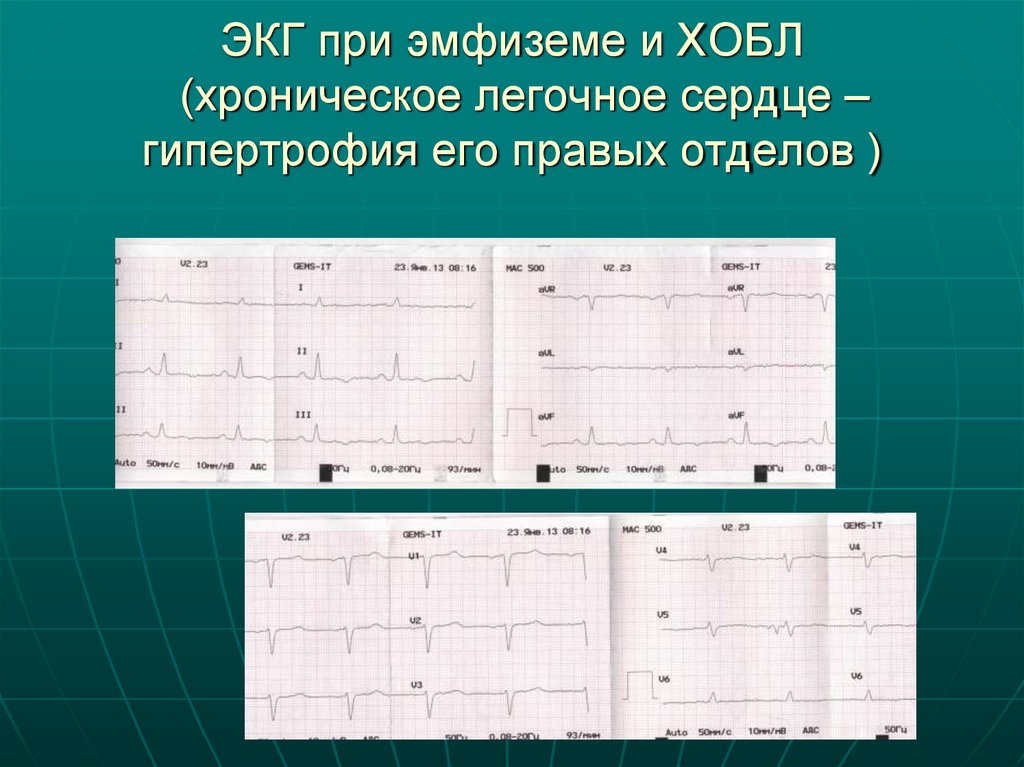 ЭКГ при эмфиземе и ХОБЛ (хроническое легочное сердце – гипертрофия его правых отделов )