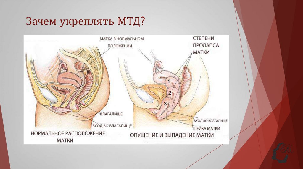 Зачем укреплять МТД?