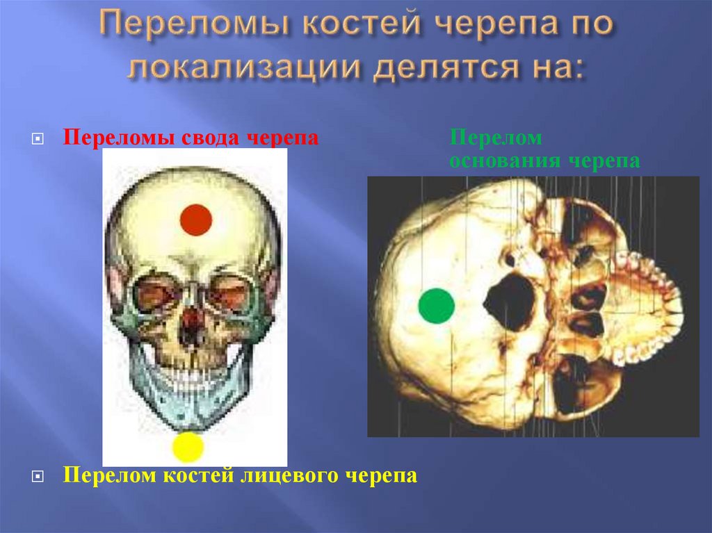 Переломы костей черепа по локализации делятся на: