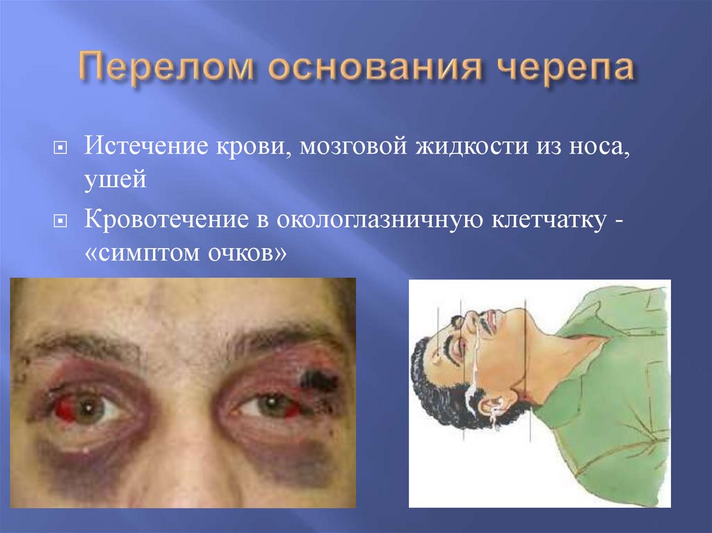 Перелом основания черепа