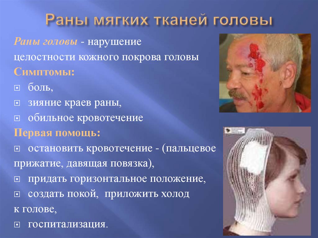 Раны мягких тканей головы