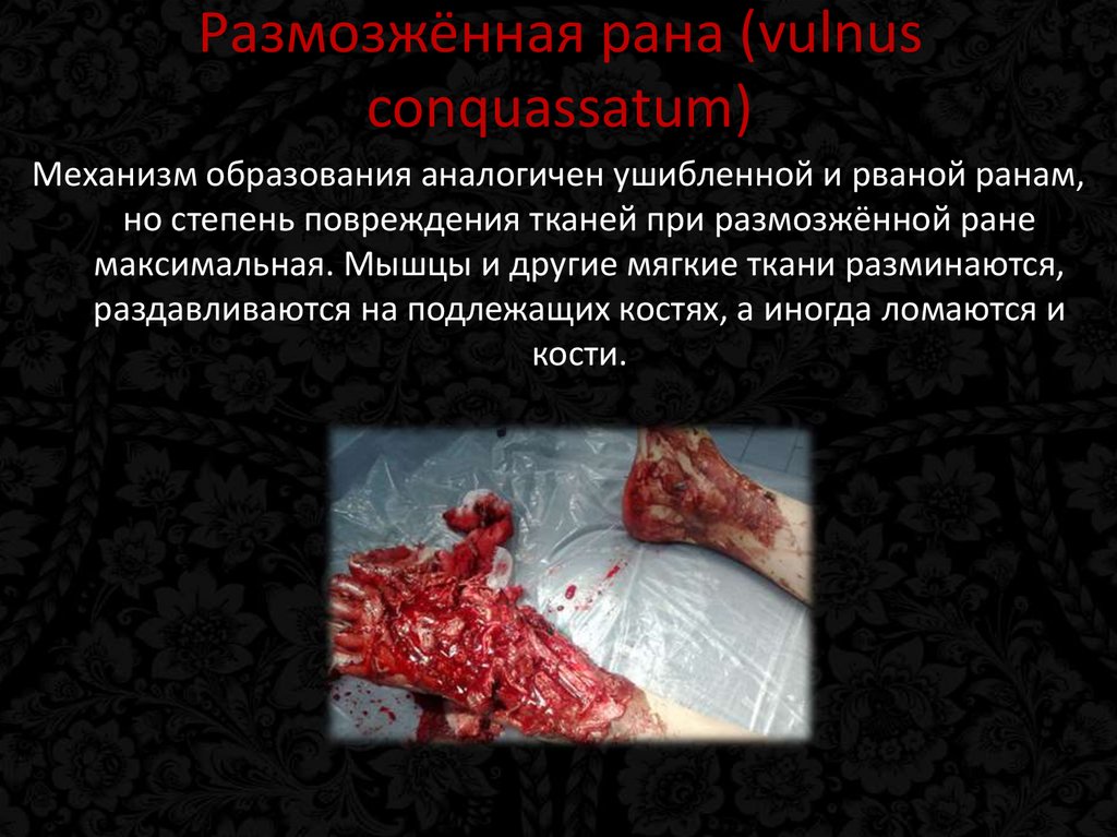 Размозжённая рана (vulnus conquassatum)