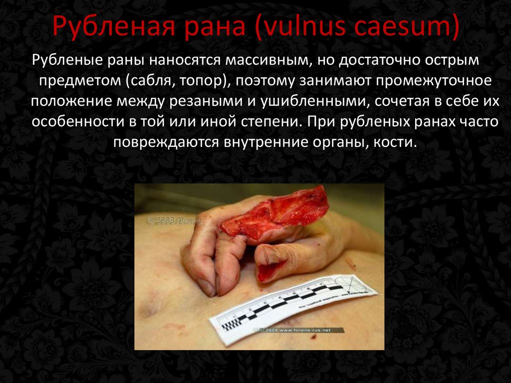 Рубленая рана (vulnus caesum)