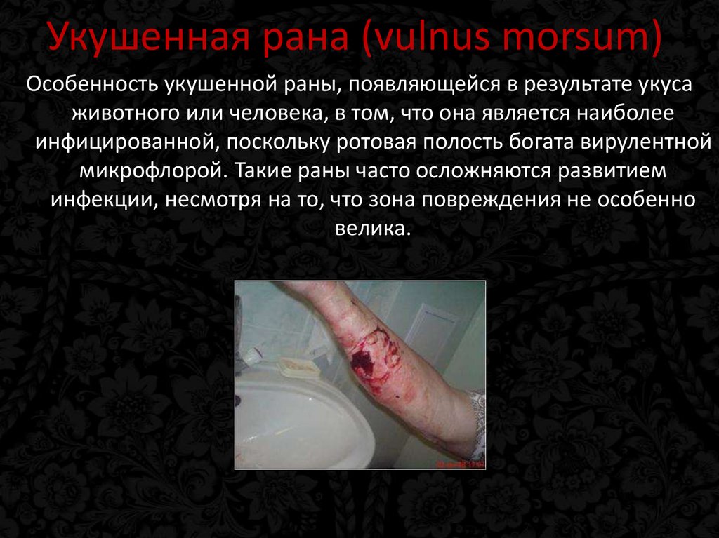 Укушенная рана (vulnus morsum)