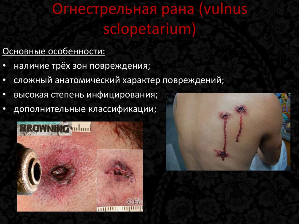 Огнестрельная рана (vulnus sclopetarium)