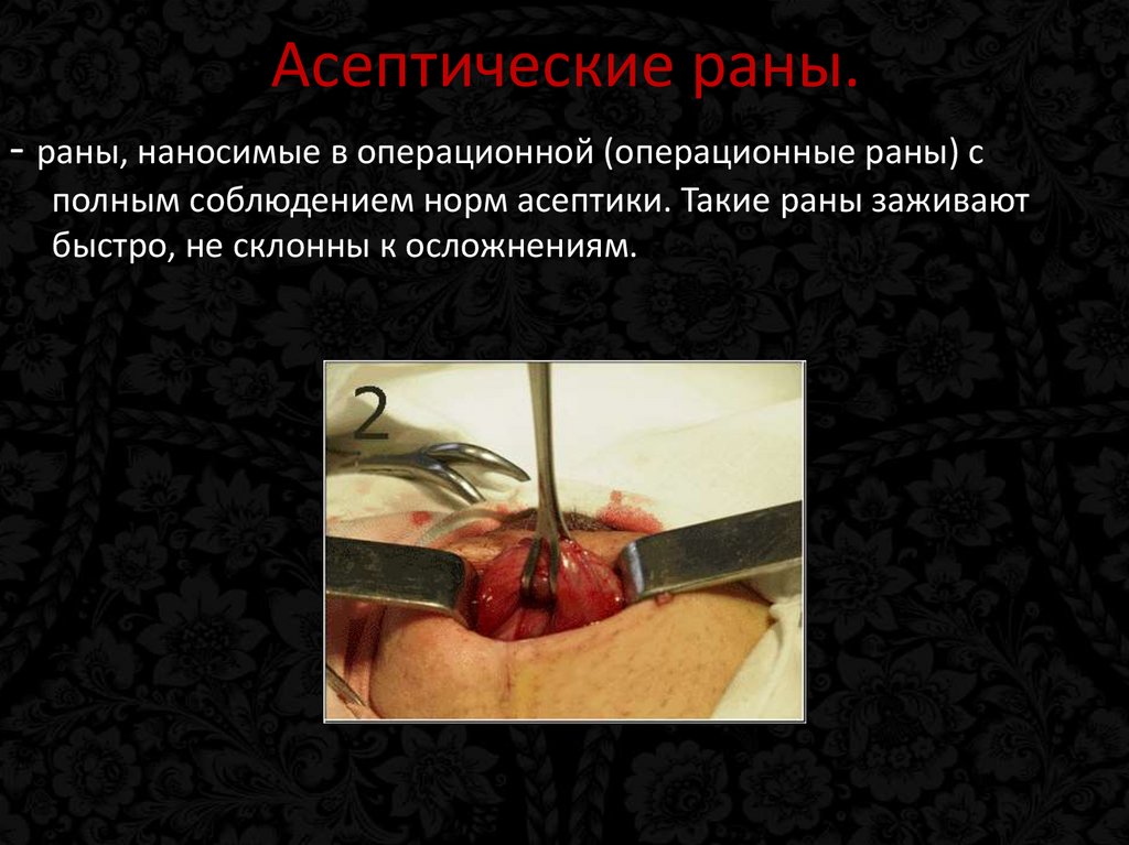 Асептические раны.