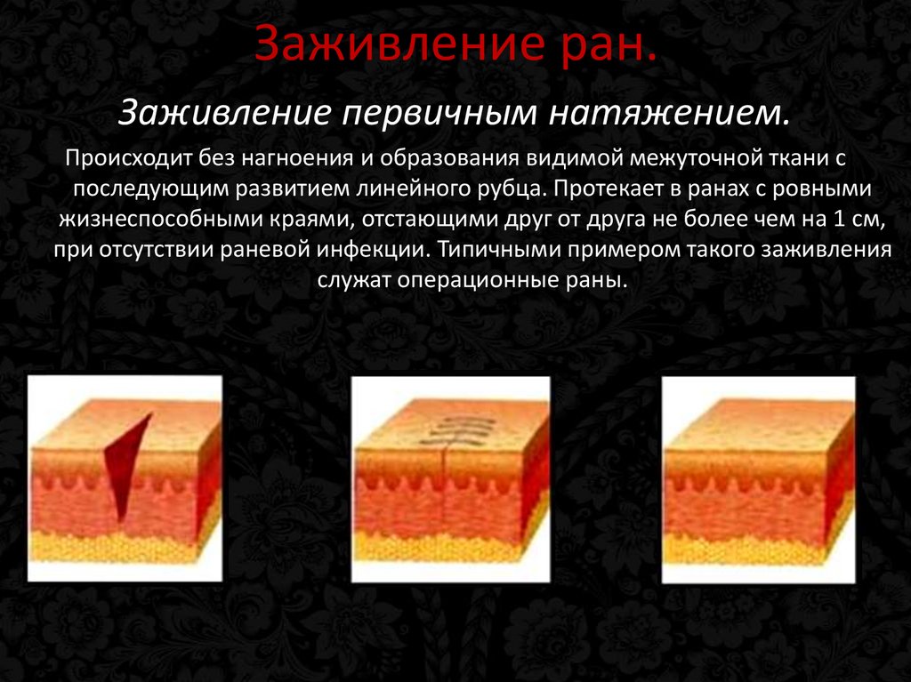 Заживление ран.