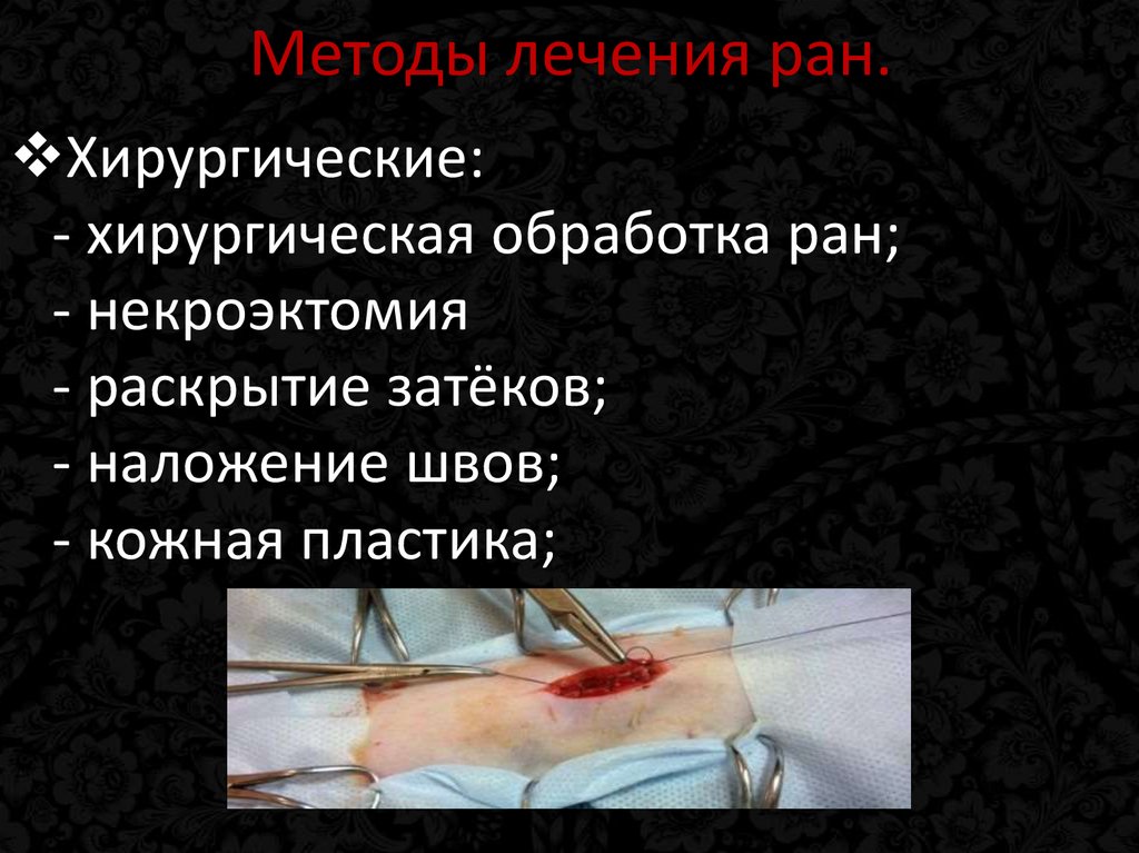 Методы лечения ран.
