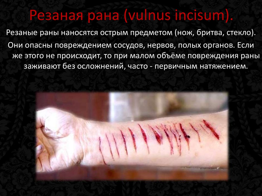Резаная рана (vulnus incisum).