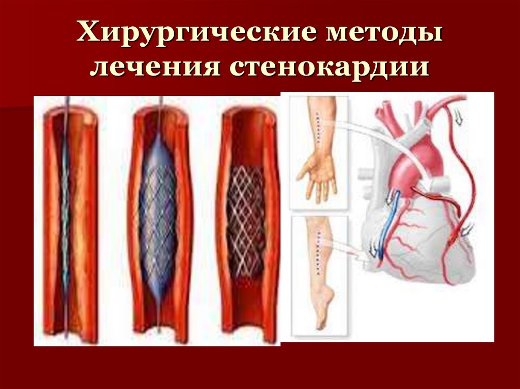 Хирургические методы лечения стенокардии